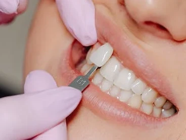 Tooth Colored Fillings